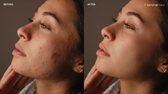 Blemish Removal-02-02 Porträtbearbeitung mit Bokeh-KI